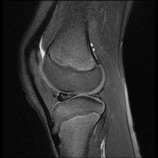 File:Bucket handle tear - lateral meniscus (Radiopaedia 72124-82634 Sagittal PD fat sat 5).jpg