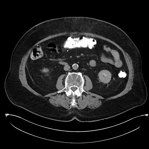 Buried bumper syndrome - gastrostomy tube (Radiopaedia 63843-72577 Axial Inject 56).jpg