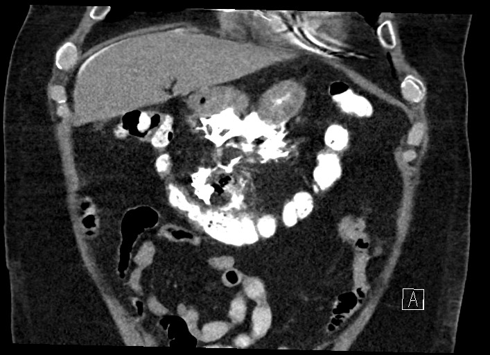 File:Buried bumper syndrome - gastrostomy tube (Radiopaedia 63843-72577 Coronal Inject 38).jpg