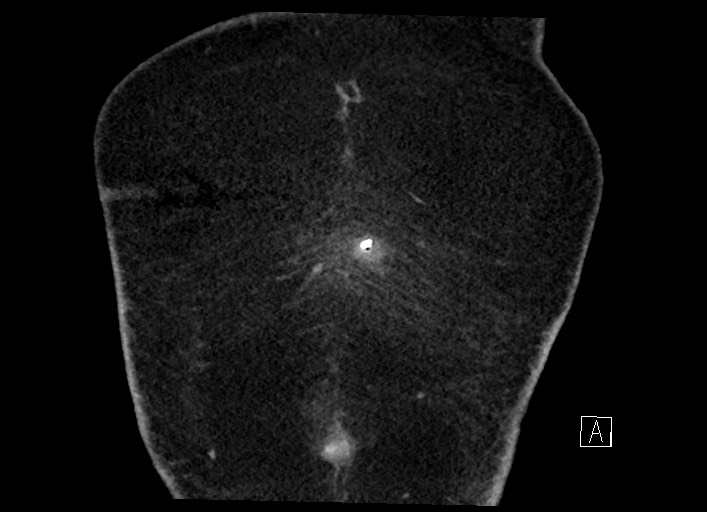 Buried bumper syndrome - gastrostomy tube (Radiopaedia 63843-72577 Coronal Inject 6).jpg