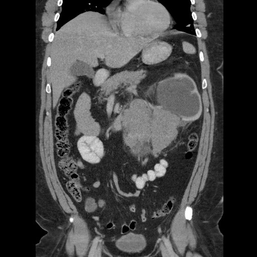 Burned-out testicular seminoma - retroperitoneal nodal metastases (Radiopaedia 62872-71245 B 28).jpg