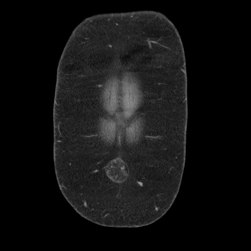 Burned-out testicular seminoma - retroperitoneal nodal metastases (Radiopaedia 62872-71245 B 5).jpg
