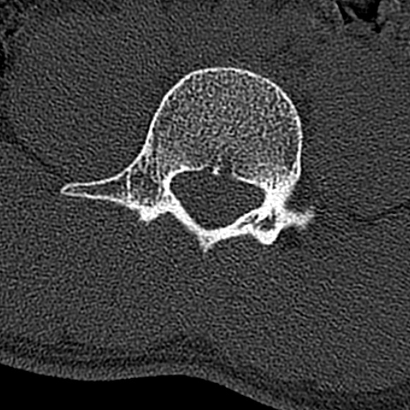 File:Burst fracture (Radiopaedia 53373-59357 Axial bone window 46).jpg