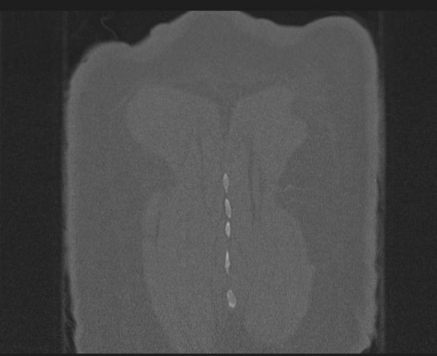 Burst fracture - thoracic spine (Radiopaedia 30238-30865 Coronal bone window 154).jpg