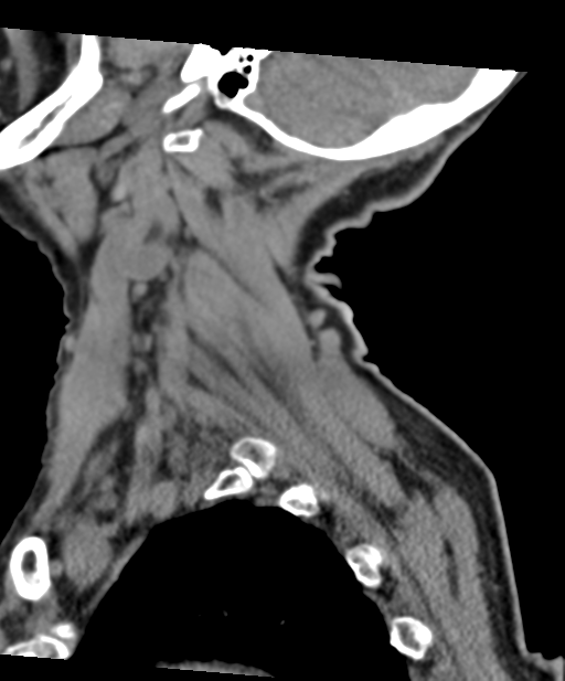 C2 fracture with vertebral artery dissection (Radiopaedia 37378-39199 D 16).png