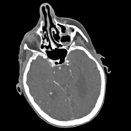 C2 fracture with vertebral artery dissection (Radiopaedia 37378-39200 A 230).png