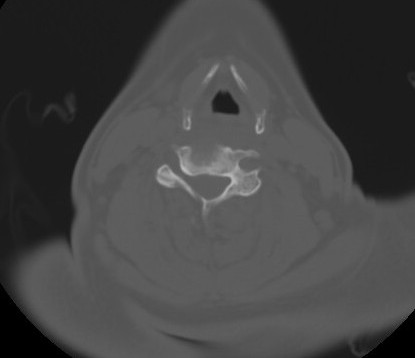 File:C7 laminar fracture and Klippel-Feil syndrome (Radiopaedia 86710-102850 Axial bone window 45).jpg