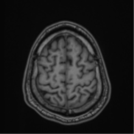 CNS vasculitis (Radiopaedia 55715-62263 Axial T1 84).png