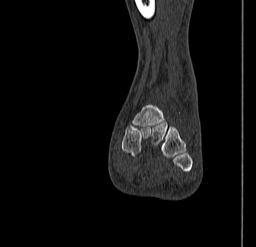 Calcaneal fracture - Sanders type 4 (Radiopaedia 90179-107370 Coronal bone window 50).jpg