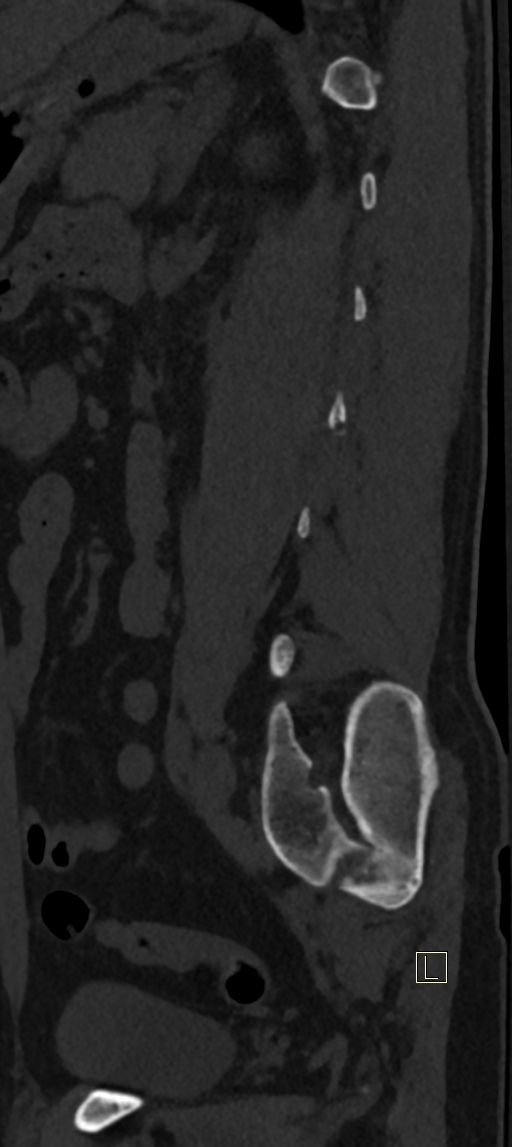Calcaneal fractures with associated L2 burst fracture (Radiopaedia 71671-82493 Sagittal bone window 12).jpg