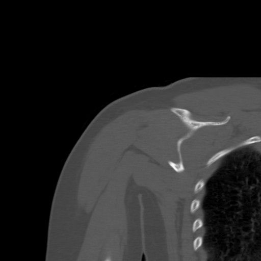 File:Calcific tendinitis of the infraspinatus tendon (Radiopaedia 87256-103539 Coronal bone window 40).jpg