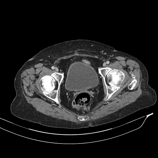 Calcified adrenal glands and Spigelian hernia (Radiopaedia 49741-54988 A 229).jpg