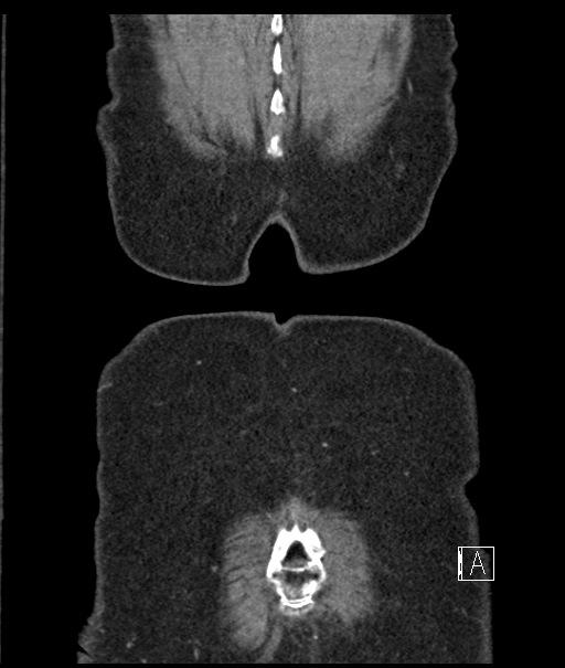 Calcified adrenal glands and Spigelian hernia (Radiopaedia 49741-54988 B 116).jpg