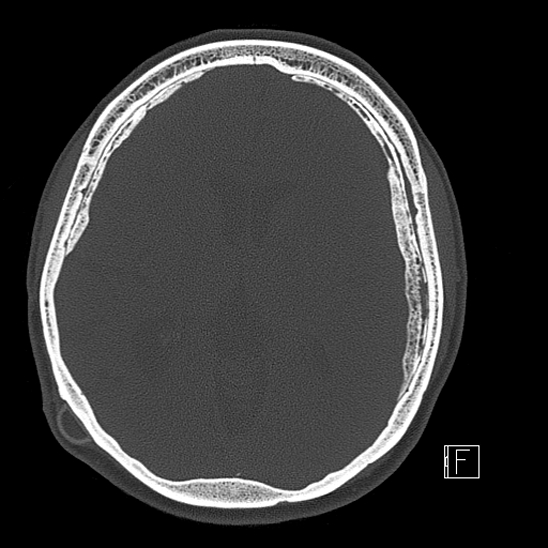 Calcified chronic subdural hematoma (Radiopaedia 77374-89492 Axial bone window 71).jpg