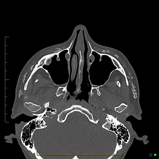 Calcified facial augmentation fillers (Radiopaedia 79514-92679 Axial bone window 22).jpg
