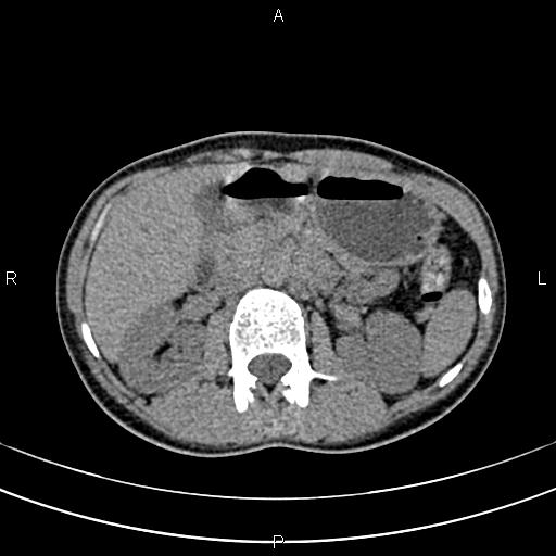 File:Calcified hepatic hydatid cyst (Radiopaedia 83870-99072 Axial non-contrast 65).jpg