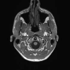 Callosal dysgenesis with interhemispheric cyst (Radiopaedia 53355-59335 Axial T1 6).jpg