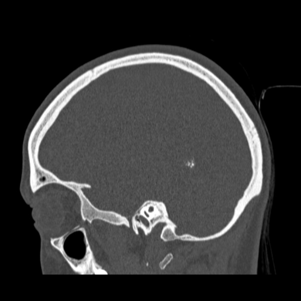Calvarial osteoma (Radiopaedia 36520-38079 Sagittal bone window 75).jpg