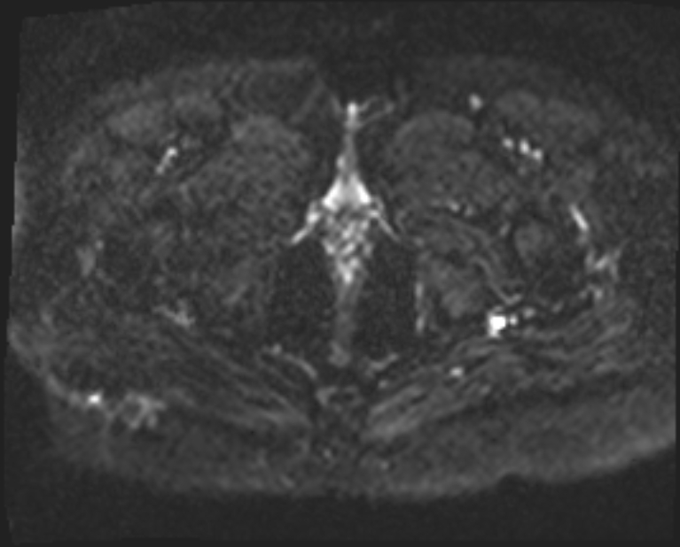 Cancer cervix - stage IIb (Radiopaedia 75411-86615 Axial DWI 1).jpg