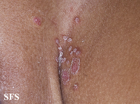 File:Candidiasis (Dermatology Atlas 30).jpg