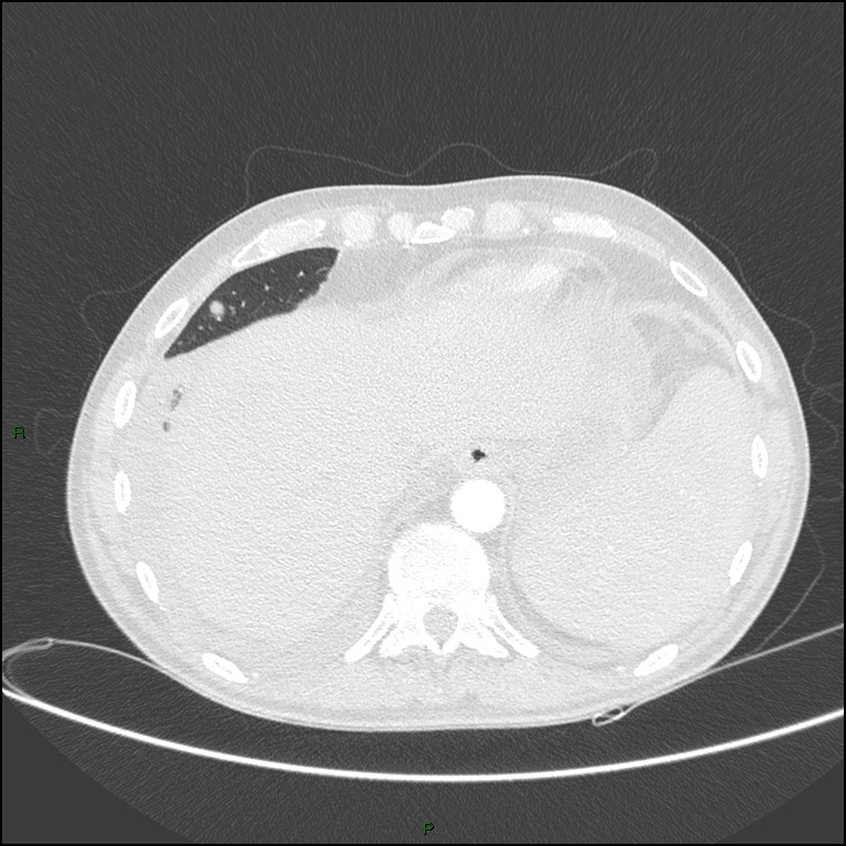 Cannonball metastases (Radiopaedia 82110-96150 Axial lung window 160).jpg