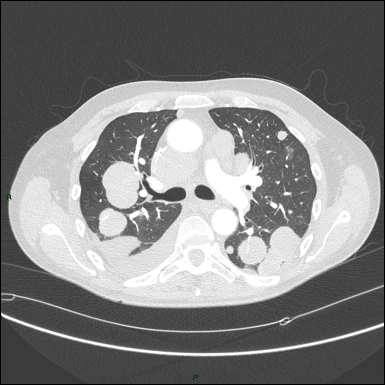 Cannonball metastases (Radiopaedia 82110-96150 Axial lung window 83).jpg