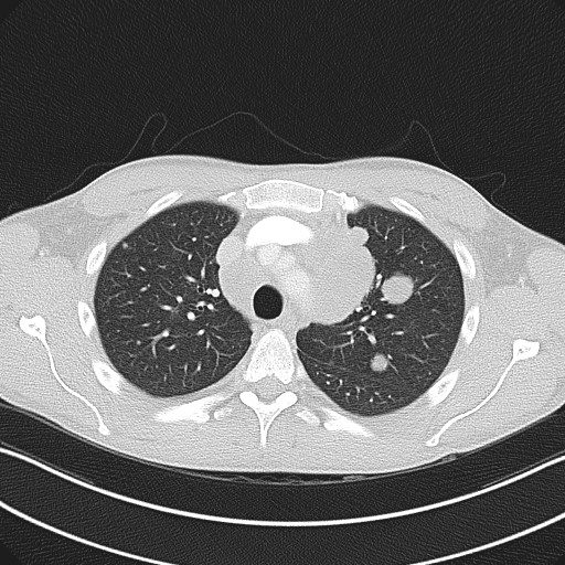 Cannonball metastases - testicular choriocarcinoma (Radiopaedia 84510-99891 Axial lung window 30).jpg