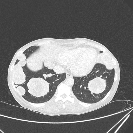 Canonball lung metastasis (Radiopaedia 77634-89837 Axial lung window 139).jpg