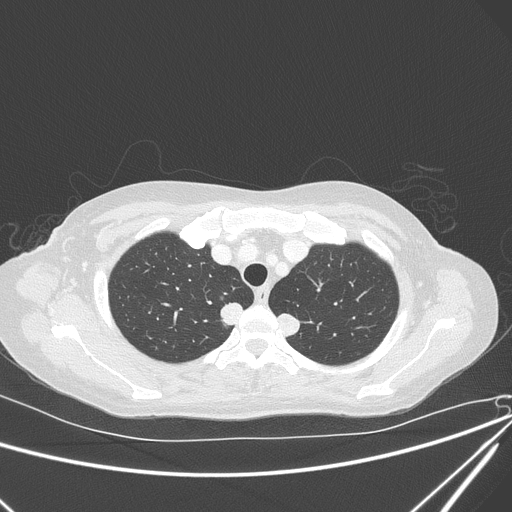 Canonball lung metastasis (Radiopaedia 77634-89837 Axial lung window 35).jpg