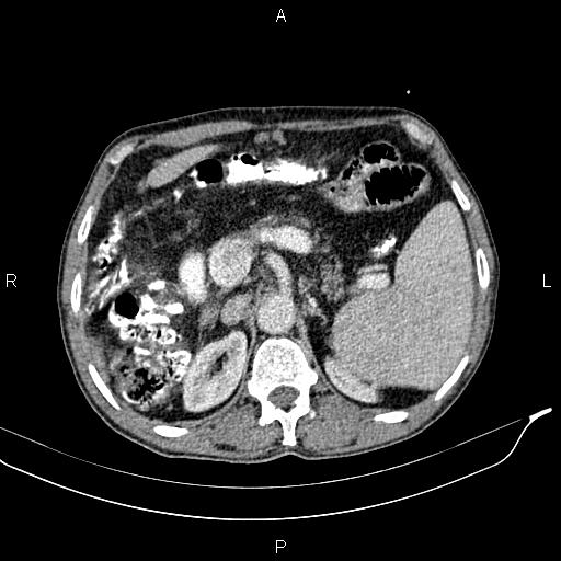 Caput medusae sign - portal hypertension (Radiopaedia 64007-72759 A 26).jpg