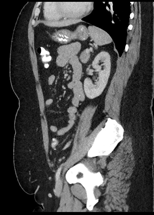 Carcinoid tumor - terminal ileum (Radiopaedia 60931-68739 C 28).jpg