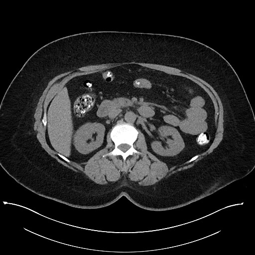 Carcinoid tumor - terminal ileum (Radiopaedia 60931-68740 Axial non-contrast 42).jpg