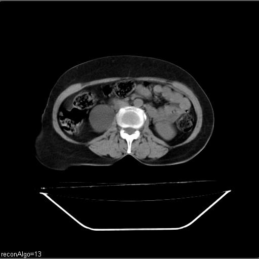 File:Carcinoma cervix- recurrence (Radiopaedia 34702-36137 Axial non-contrast 25).jpg