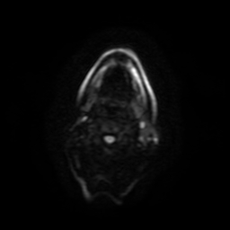 Carcinoma ex-pleomorphic adenoma of parotid (Radiopaedia 28383-28627 Ax DWI B-500 GE 47).jpg