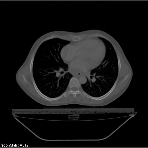 File:Carcinoma of esophagus (Radiopaedia 27356-27550 Axial bone window 16).jpg