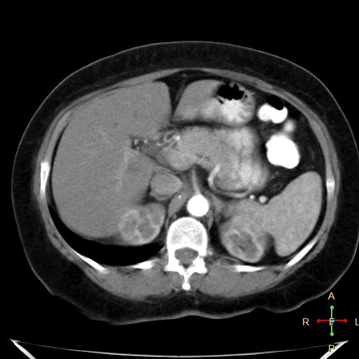 File:Carcinoma of sigmoid colon (Radiopaedia 23071-23100 C+ arterial phase 7).jpg