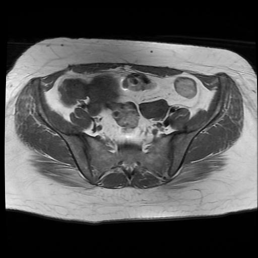 File:Carcinoma of the cervix (Radiopaedia 89018-105858 Axial T1 3).jpg