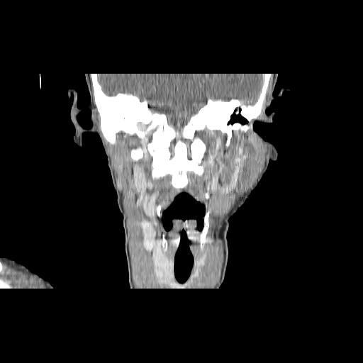 File:Carcinoma of the maxillary antrum (Radiopaedia 53805-59888 Coronal C+ delayed 100).jpg