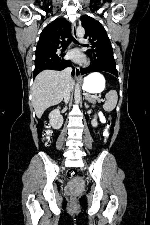 Carcinoma of uterine cervix (Radiopaedia 85861-101700 C 34).jpg