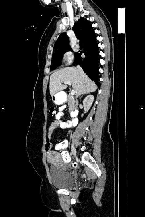 Carcinoma of uterine cervix (Radiopaedia 85861-101700 D 31).jpg