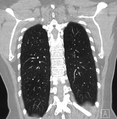 Cardiac sarcoidosis (Radiopaedia 74548-85534 Coronal lung window 56).jpg