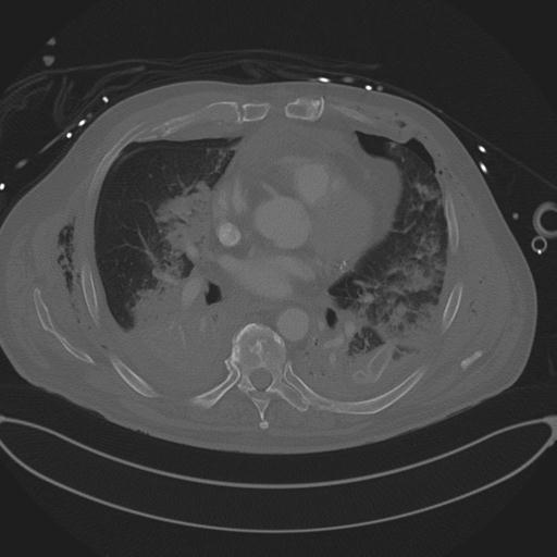 Cardiac trauma (Radiopaedia 32874-33858 Axial bone window 49).jpg