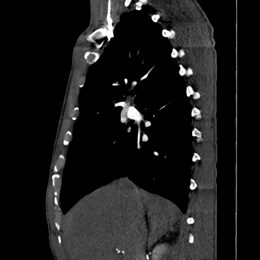 Cardiac tumor - undifferentiated pleomorphic sarcoma (Radiopaedia 45844-50134 B 53).png