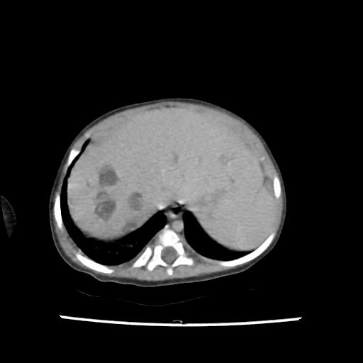 Caroli disease with autosomal recessive polycystic kidney disease (ARPKD) (Radiopaedia 89651-106703 B 26).jpg
