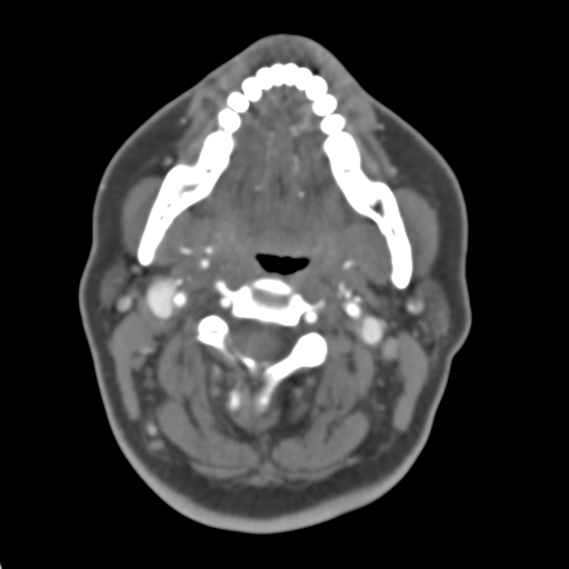 File:Carotico ophthalmic aneurysm (Radiopaedia 42916-46148 A 60).png