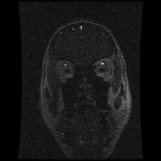 Carotid arterial dissection with acute cerebral infarction (Radiopaedia 26636-26784 MRV 132).jpg