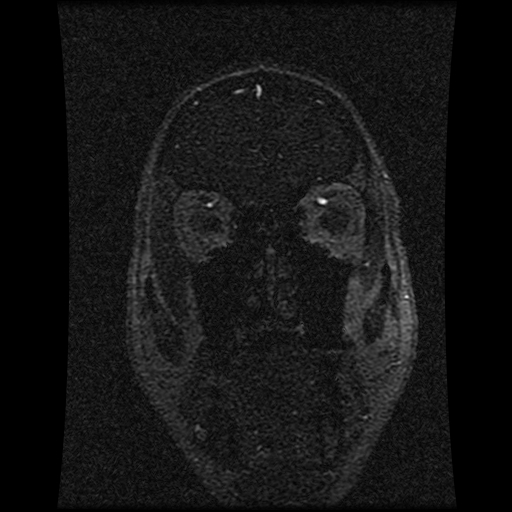 Carotid arterial dissection with acute cerebral infarction (Radiopaedia 26636-26784 MRV 133).jpg