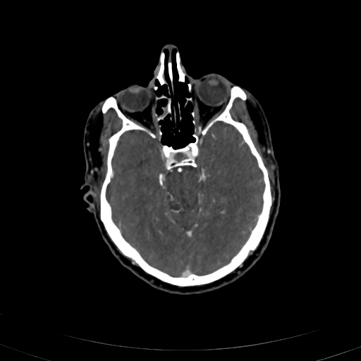 File:Carotid body tumor (Radiopaedia 83615-98727 A 6).jpg