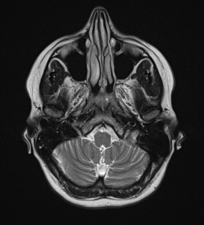 File:Cavernoma with bleed - midbrain (Radiopaedia 54546-60774 Axial T2 4).png