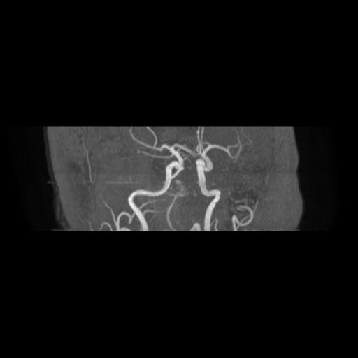 Cavernoma with developmental venous anomaly (Radiopaedia 22470-22507 MRA 13).jpg